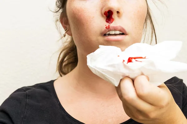 Nose bleeding