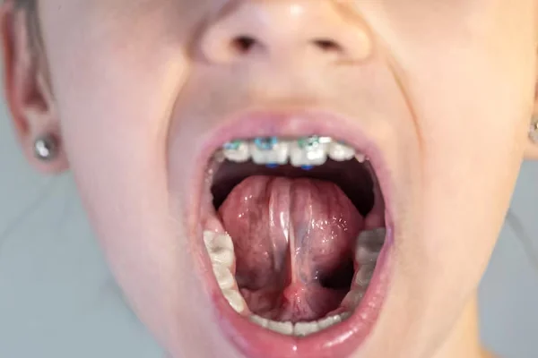 Tongue Tie Release