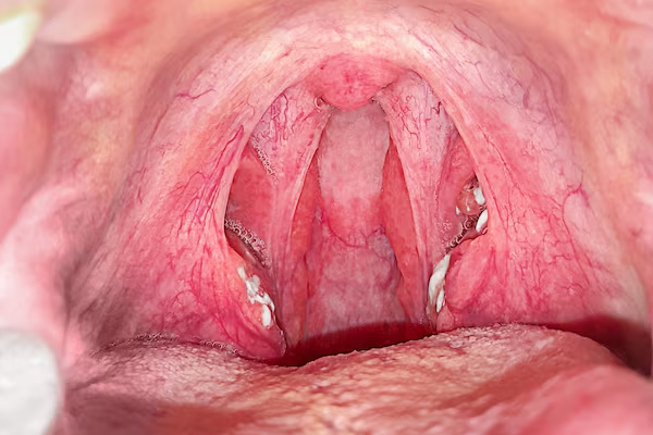 Tonsils