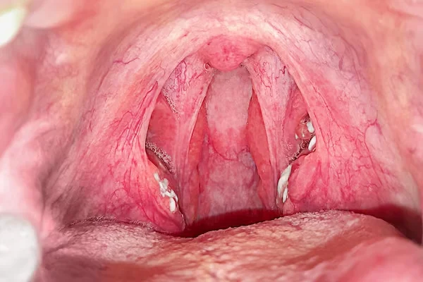 Tonsils